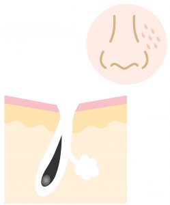 毛穴が目立つ４つの理由 原因別の毛穴スキンケア方法を大公開